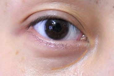 激光去眼袋多長時間能消腫？激光去眼袋能維持幾年？