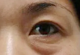 激光去眼袋會反彈嗎？