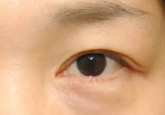 激光去眼袋術(shù)后會不會反彈？