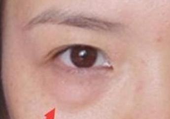 激光去眼袋的效果怎么樣？激光去眼袋注意事項(xiàng)有哪些？