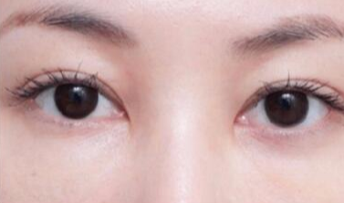 激光去眼袋術(shù)后注意事項有哪些？