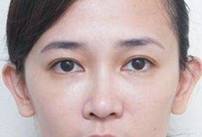 激光去眼袋后要休息多久呢？激光去眼袋會很痛嗎？