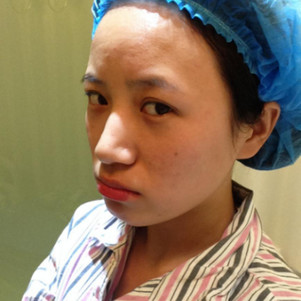 全臉脂肪填充效果對(duì)比圖