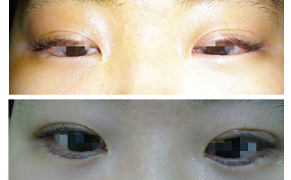 眼瞼內(nèi)翻什么意思？眼瞼內(nèi)翻怎么辦？