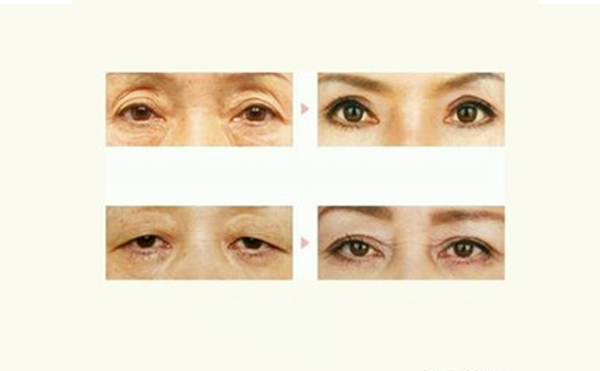 三角眼矯正效果受什么影響?多少錢?