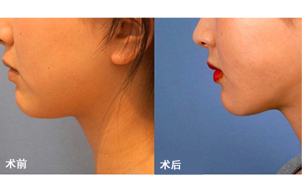 面部吸脂后皮膚會不會松弛？