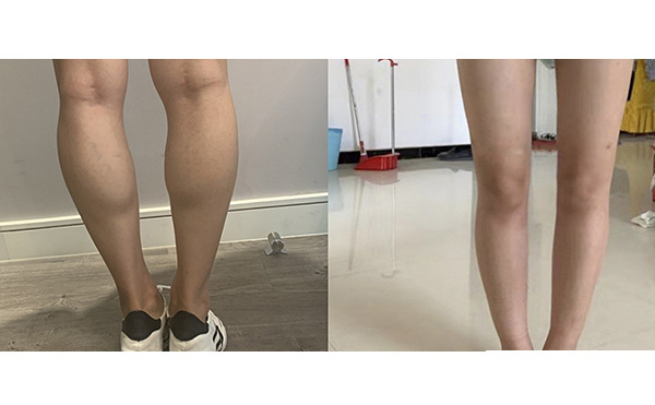 瘦腿針和吸脂哪個(gè)好？