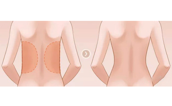 背部吸脂手術(shù)的關(guān)鍵在哪個(gè)部位？