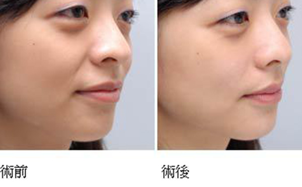 玻尿酸去法令紋需要多久能恢復(fù)？