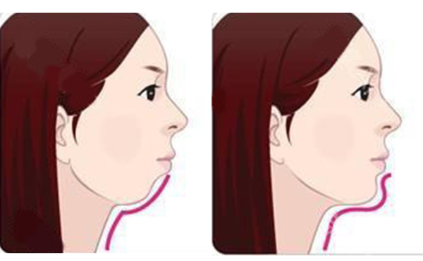 注射墊下巴的方式好嗎?