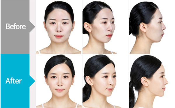 改臉型手術(shù)哪家好？