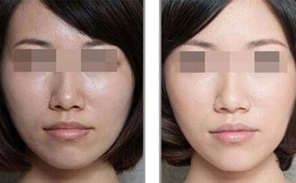 美白針的效果怎么樣？