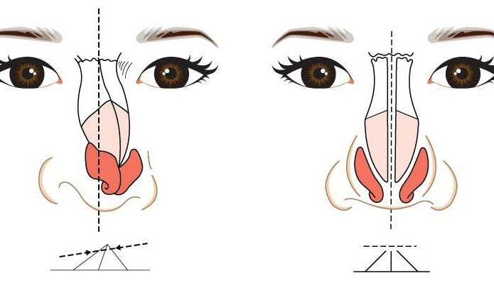 鼻子歪矯正大約多少錢(qián)？鼻子歪矯正恢復(fù)期多久？