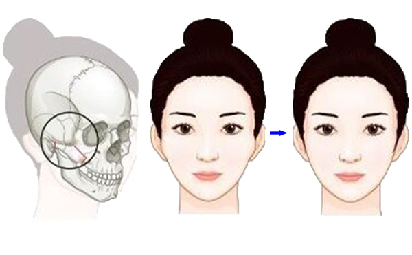顴骨降低整形手術(shù)是怎么操作的？有什么特點？