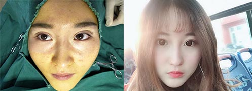 雙眼皮修復效果對比圖1