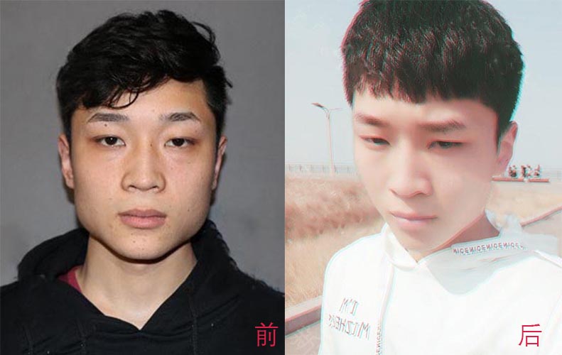 瘦臉針、面部吸脂如何選擇？