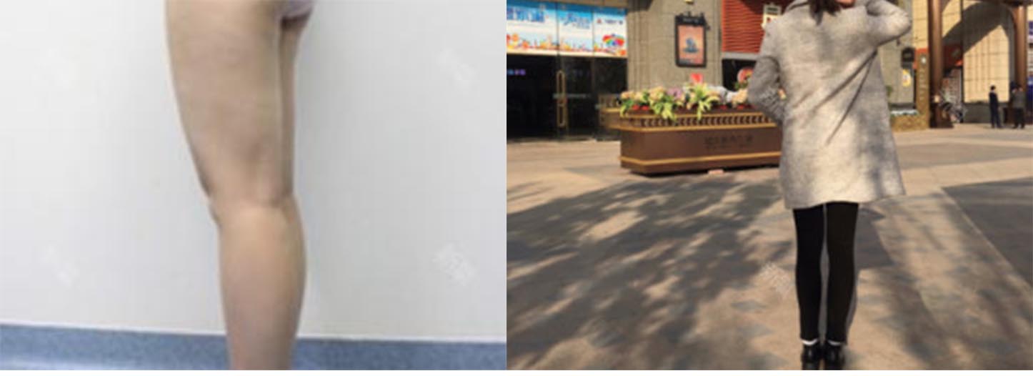 太原時光整形大腿吸脂術(shù)前術(shù)后效果圖