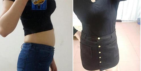 腹部吸脂前后對比