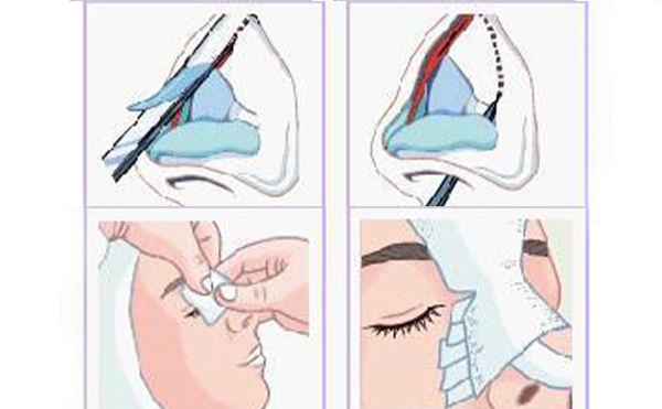 鼻小柱延長(zhǎng)手術(shù)材料有哪些？這些材料有什么優(yōu)勢(shì)