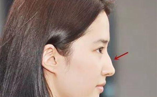 駝峰鼻要怎么改善？