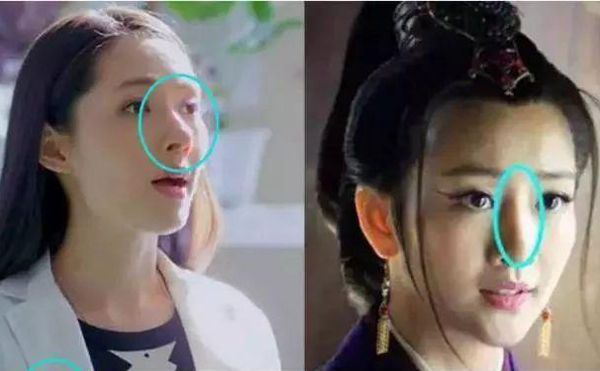 假體隆鼻安全嗎?假體會(huì)不會(huì)發(fā)生移動(dòng)?