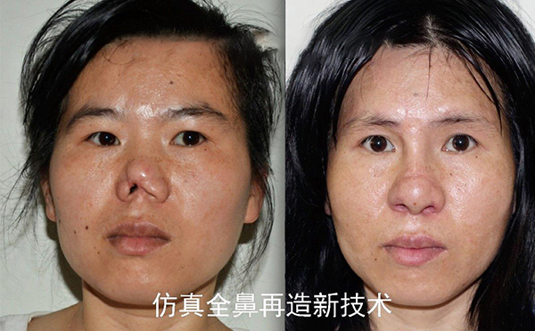 怎么做鼻再造手術?鼻再造的過程是怎樣的
