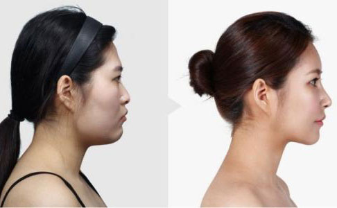 隆鼻手術(shù)多久恢復(fù)自然？