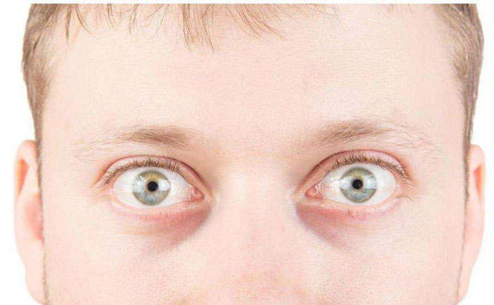 眼球突出是什么原因引起的？眼球突出如何矯正？