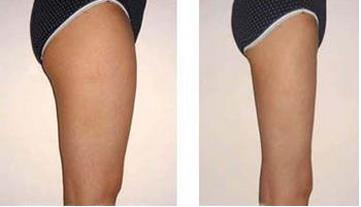 臀部抽脂會留疤嗎？