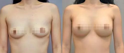 假體隆胸手術(shù)效果對比圖2