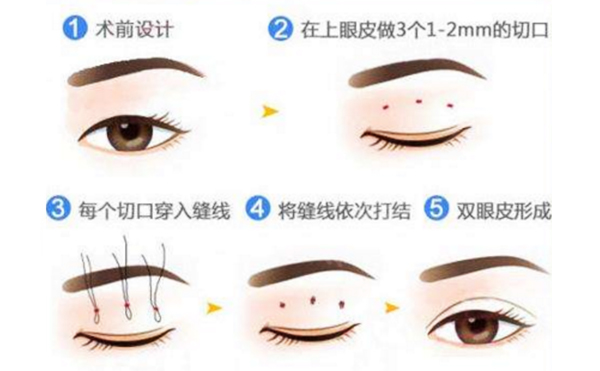 微創(chuàng)雙眼皮怎么做出來?微創(chuàng)雙眼皮幾天消腫?