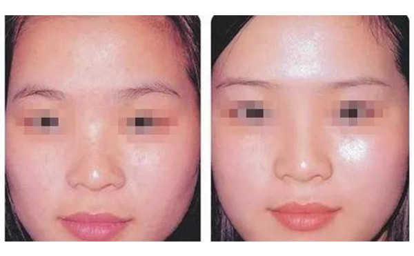 水光注射疼不疼？