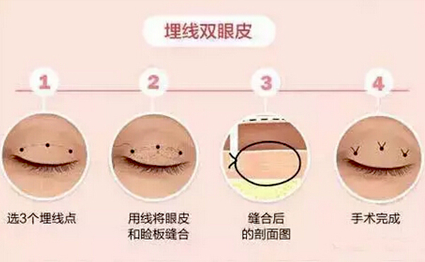 全切雙眼皮跟埋線的區(qū)別是什么？哪個(gè)好？