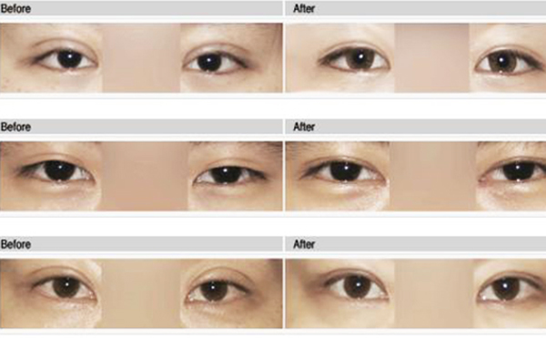 雙眼皮手術(shù)失敗如何修復(fù)呢?需要多長時間?
