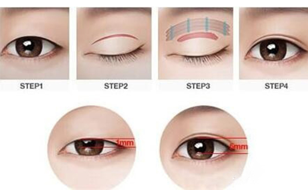 什么樣的人不適合做雙眼皮?做雙眼皮什么季節(jié)合適呢?