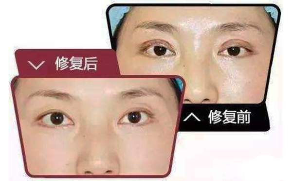 哪些情況需做雙眼皮修復？修復難度大不大?