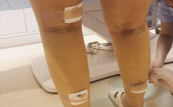 腿部吸脂的部位有哪些？