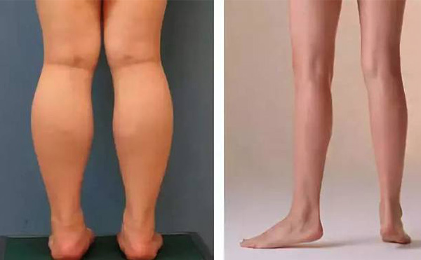 腿部吸脂疼不疼？