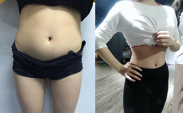 環(huán)吸抽脂有什么優(yōu)勢(shì)？