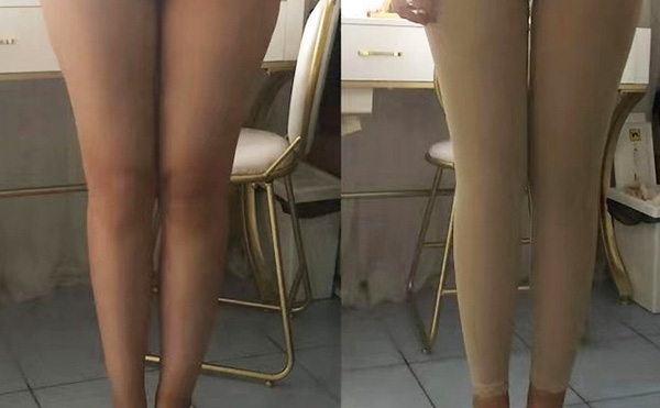 環(huán)吸抽脂疼不疼？