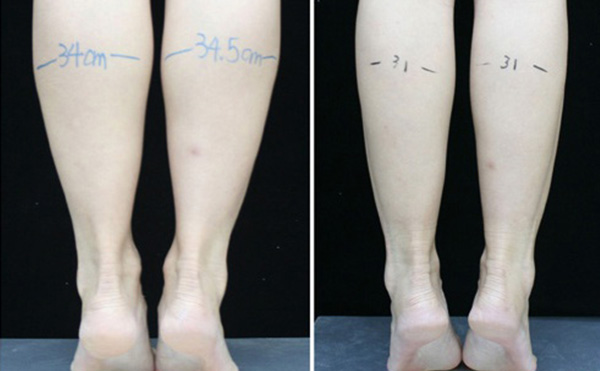 瘦腿針可以維持多長時間？