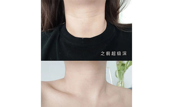 激光去頸紋適合哪些人？