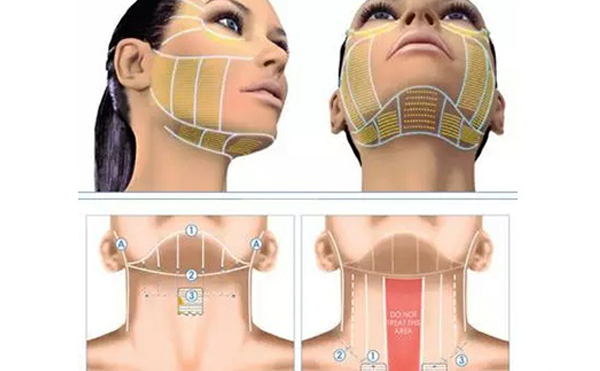 超聲刀怎么祛除頸紋？