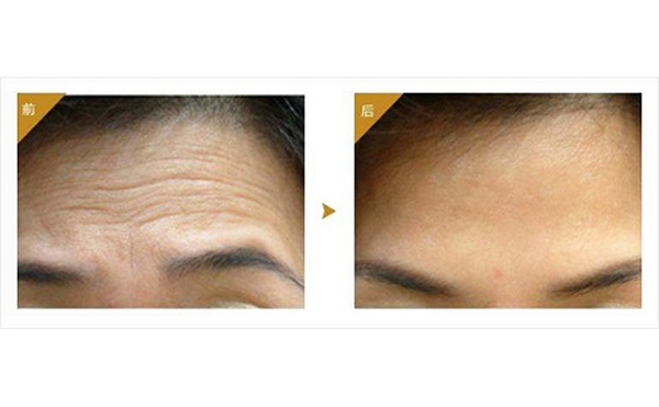 注射玻尿酸注意事項有哪些？