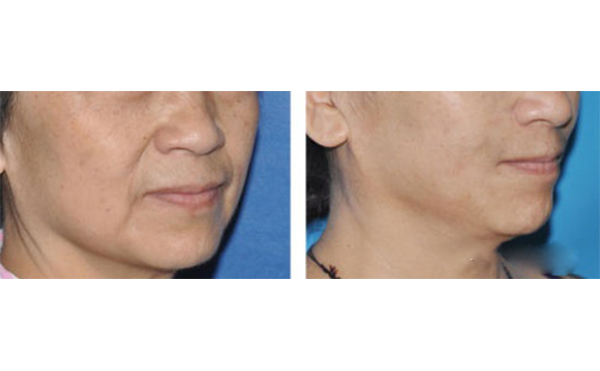 筋膜懸吊除皺適合哪些人？