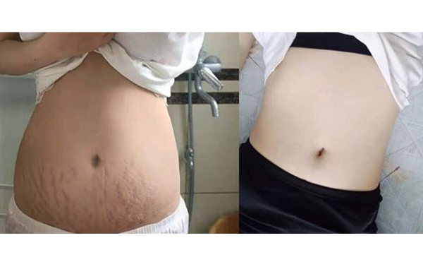 激光可以去除妊娠紋嗎？