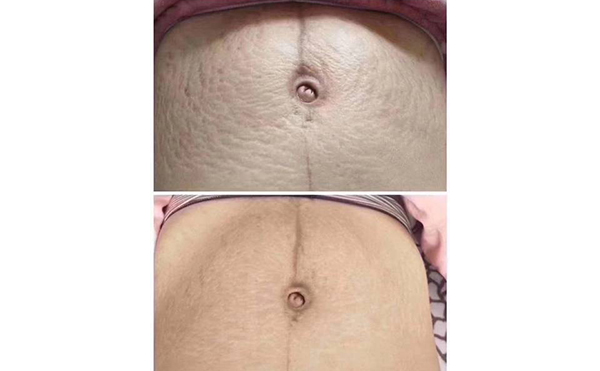 激光去妊辰紋多少錢？