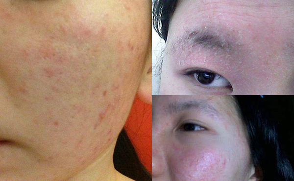 果酸煥膚安全嗎？