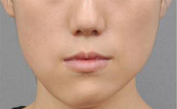 哪些小習(xí)慣會(huì)導(dǎo)致面部不對(duì)稱?