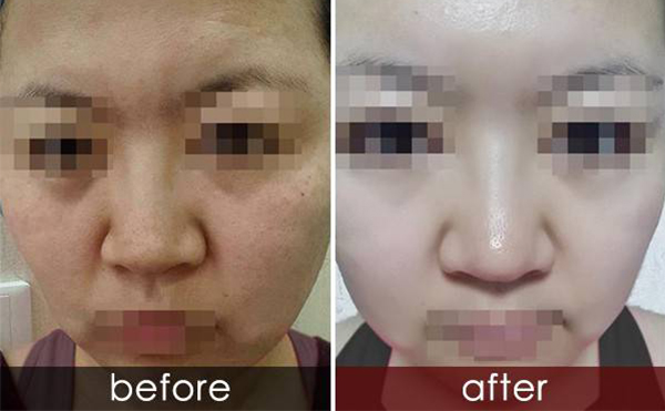 白瓷娃娃有什么副作用?